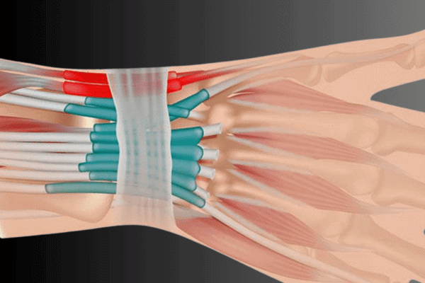 Wrist tendinitis