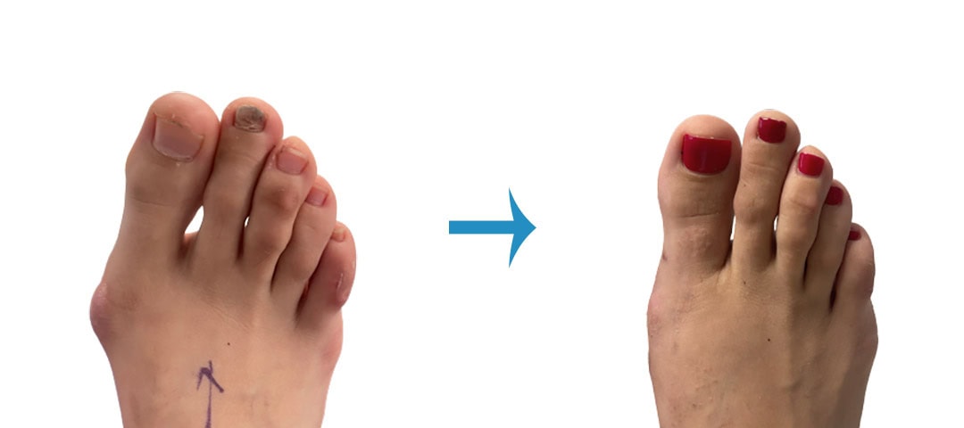 Before and after image of Minimally Invasive Bunion Surgery