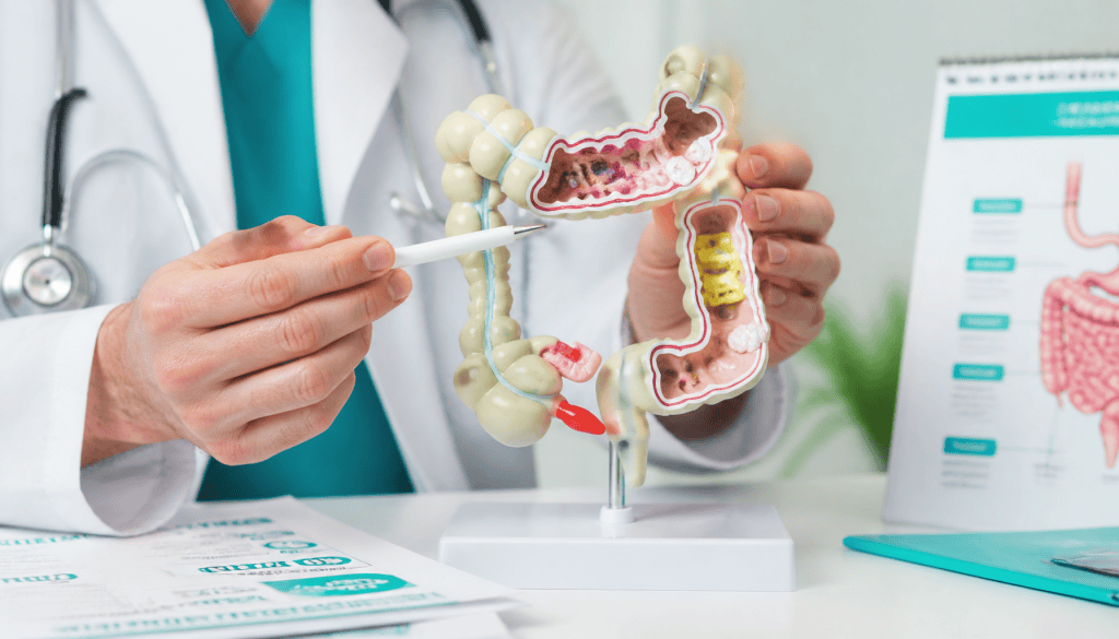 Stase stercorale colique et cancer colorectal : symptômes, risques et prise en charge