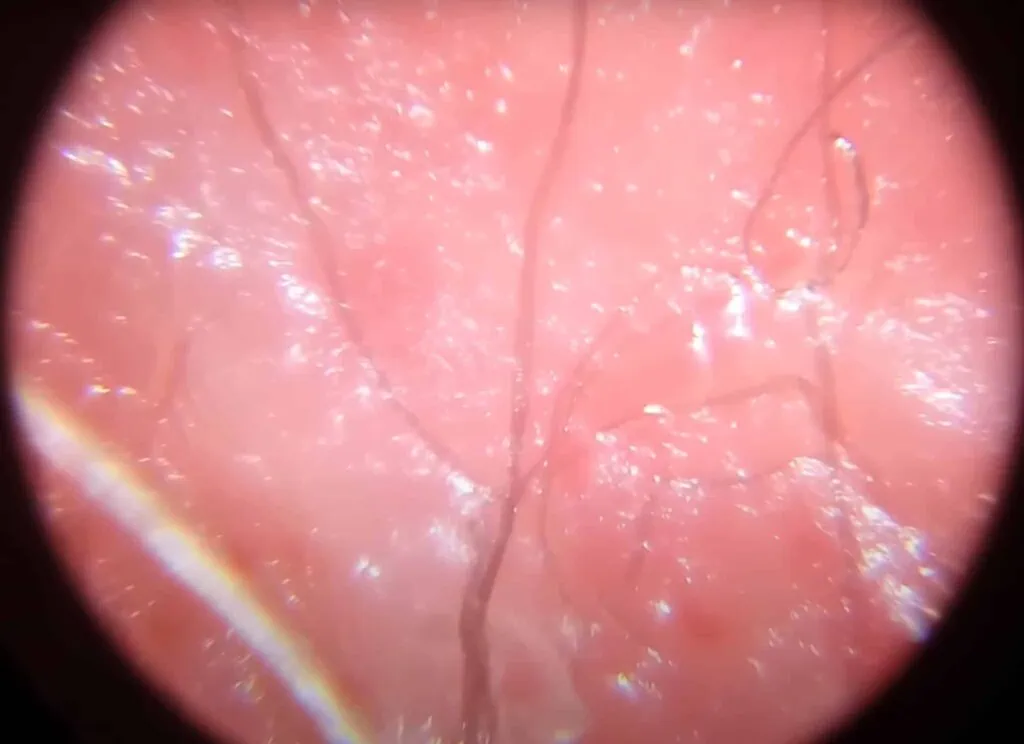 Fine dark filament-like structures embedded within pink skin tissue at approximately 120 times magnification.