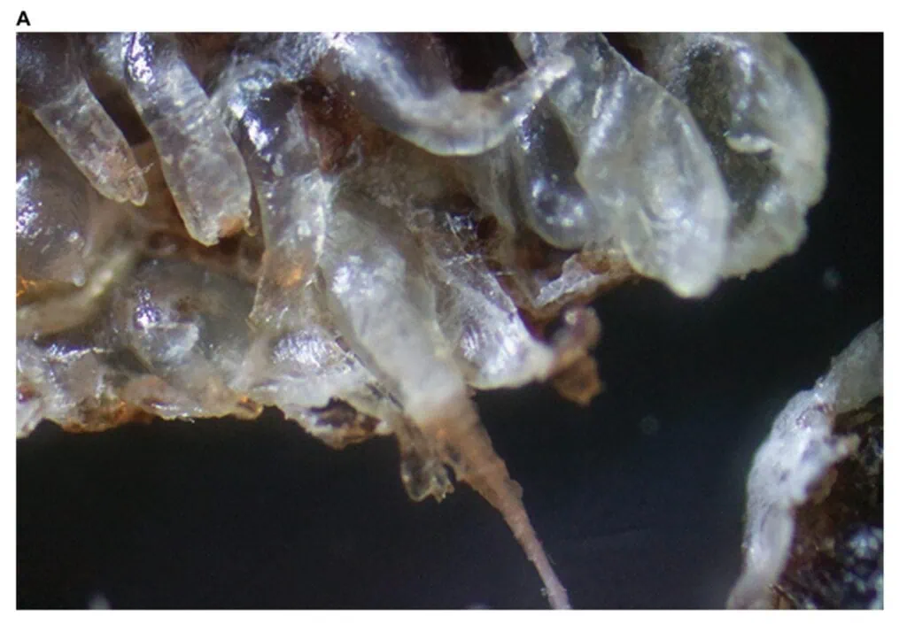 Microscopic view of thickened keratinized follicular casts and a hair in a Morgellons specimen at 100 times magnification.