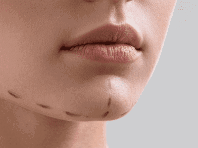 Çene Dolgusu (Jawline)