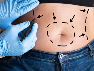 Liposuction