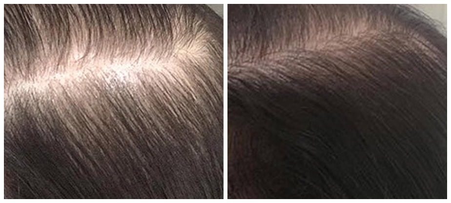 Hair restoration results after PRP (Platelet-Rich Plasma) injections for hair loss treatment