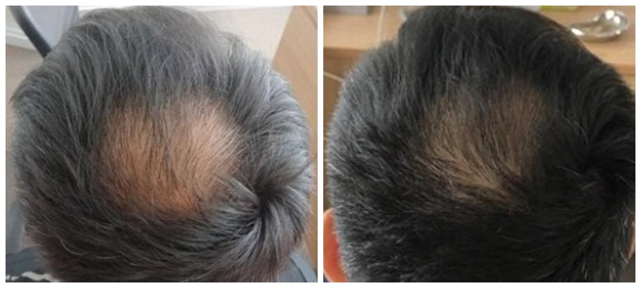 Before and after image of PRP (Platelet-Rich Plasma) treatment showing visible hair regrowth on the scalp