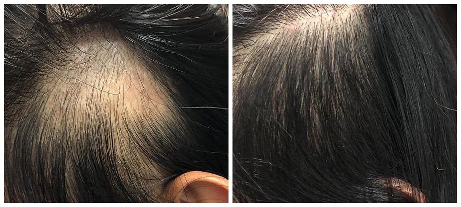 Scalp transformation with PRP therapy – improved hair density and reduced thinning