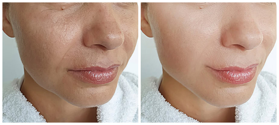 PRP (Platelet-Rich Plasma) therapy being administered to promote skin rejuvenation and natural healing