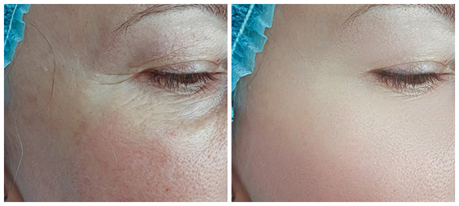 Before and after image of a woman’s face showing improved skin texture and radiance after PRP (Platelet-Rich Plasma) treatment