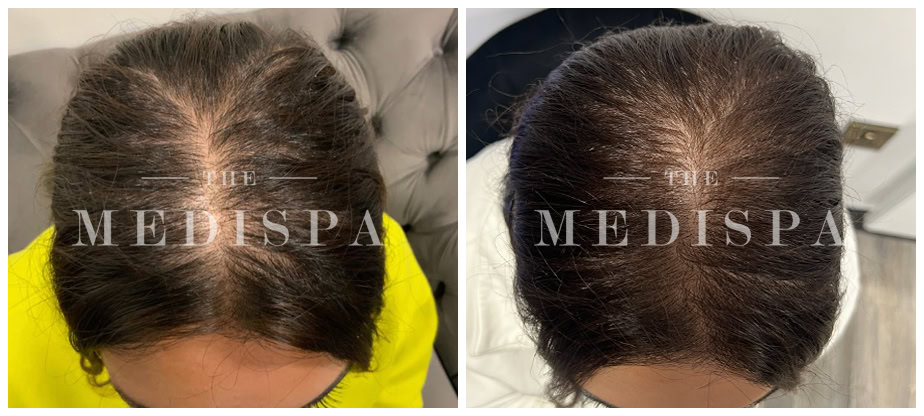 Before and after image of PRP (Platelet-Rich Plasma) treatment showing visible hair regrowth on the scalp