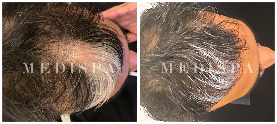 Before and after image of PRP (Platelet-Rich Plasma) treatment showing visible hair regrowth on the scalp