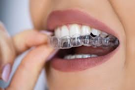 Invisalign Zahnspange