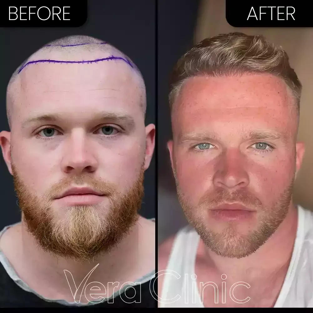Haartransplantation 4000 Grafts