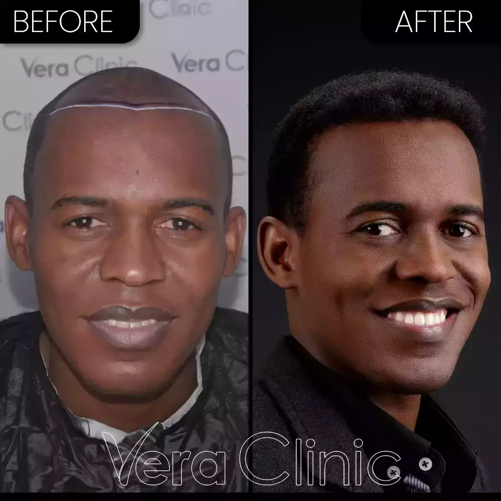 Haartransplantation 2000 Grafts