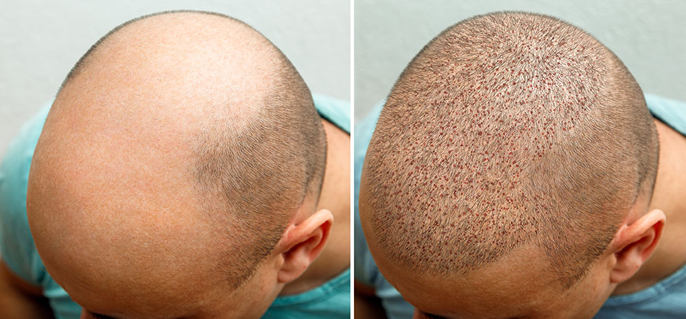 Haartransplantation Nachteile