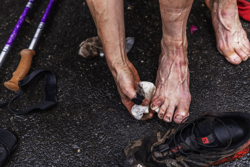 A photo of Stef Bishop's destroyed feet