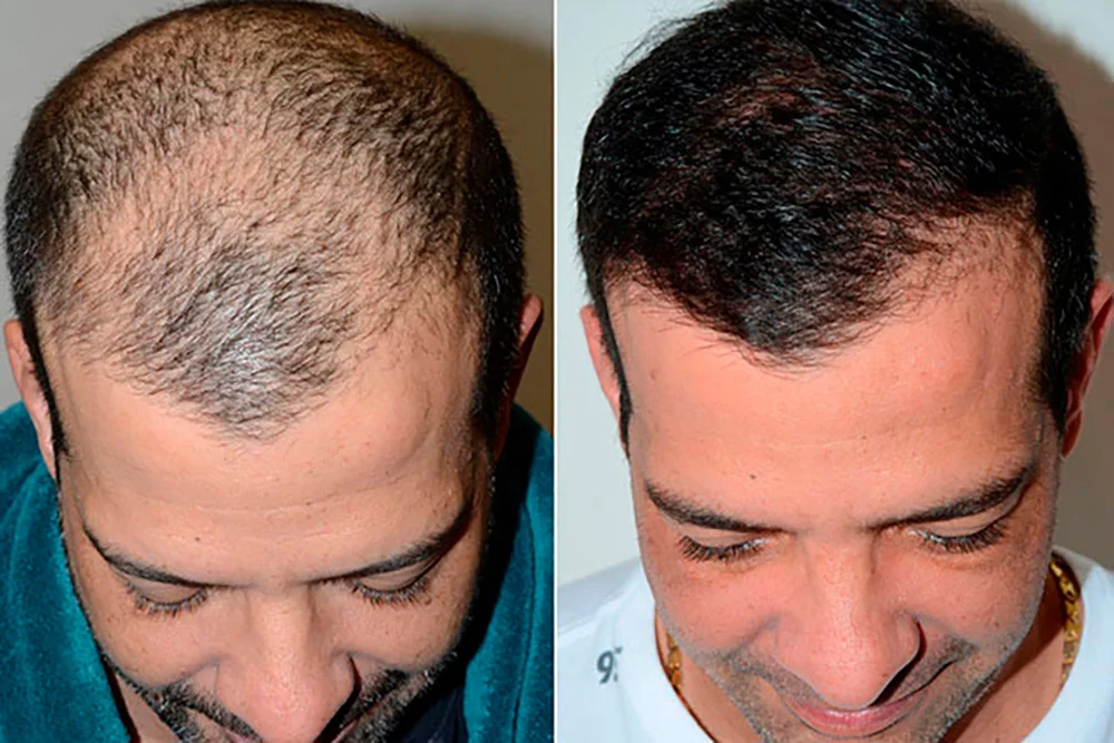 Avantages de la FUE greffe de cheveux