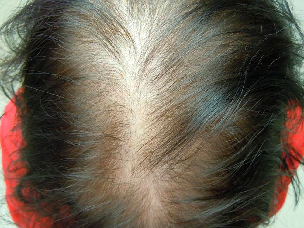 You are currently viewing HAIR DENSITY GOING FOR A TOSS? TIME TO CONSULT A HAIR FALL EXPERT