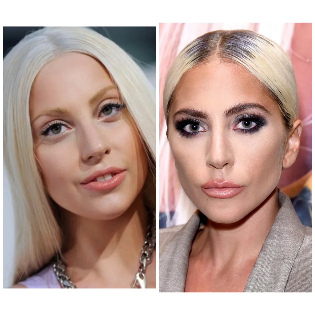 Lady Gaga's Evolution: Before and After Plastic Surgery