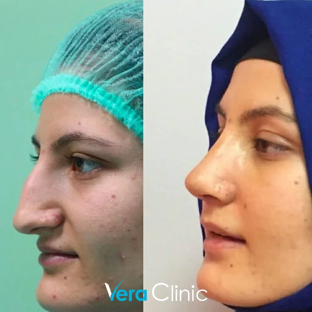 Rhinoplasty Before and After Photos