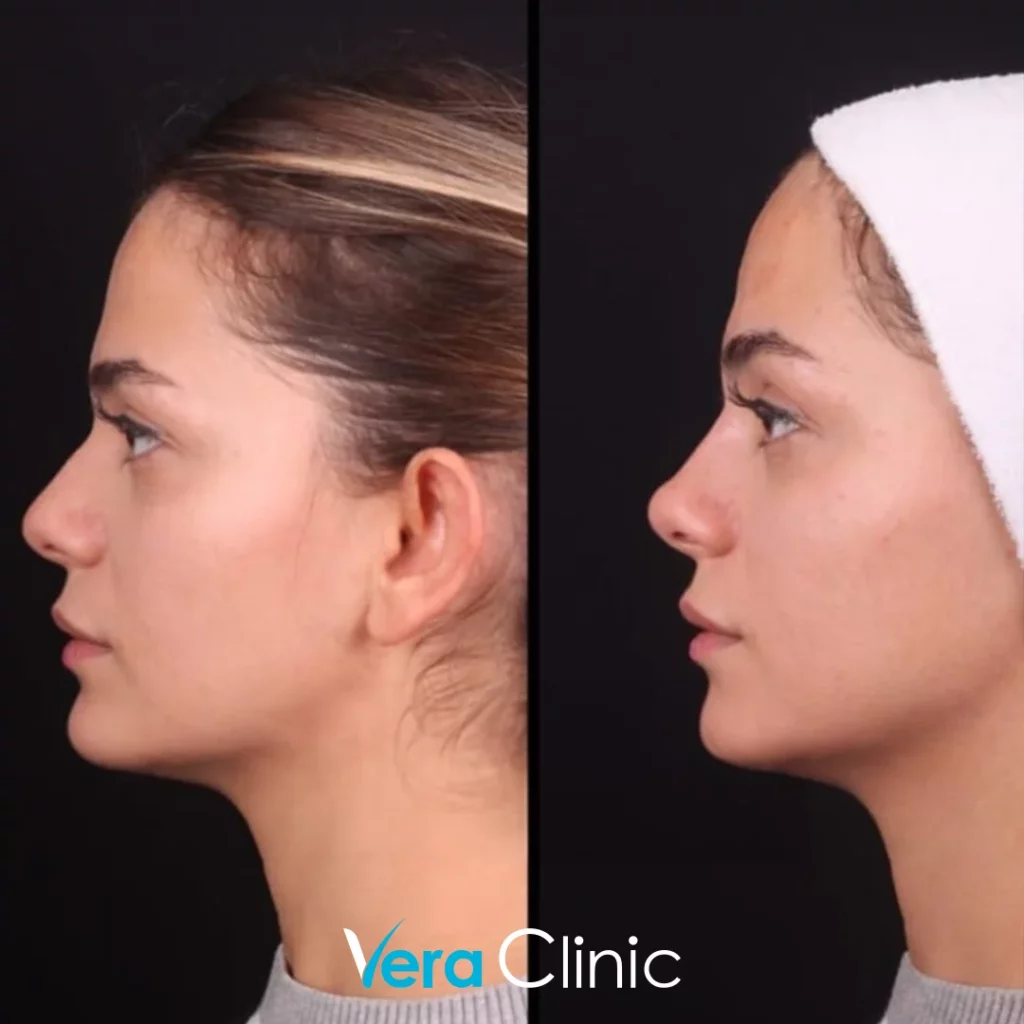 Rhinoplasty Before and After Photos