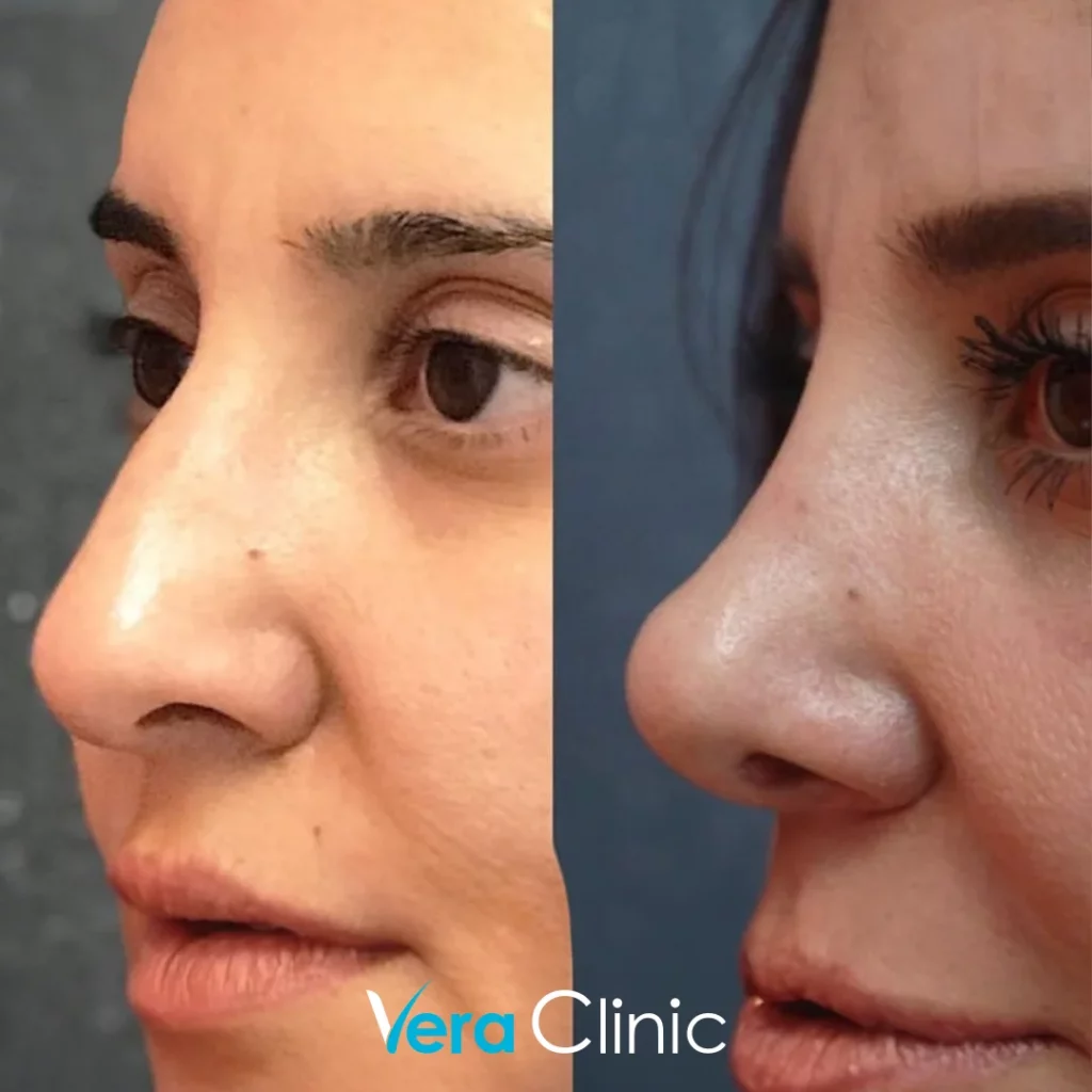 Rhinoplasty Before and After Photos