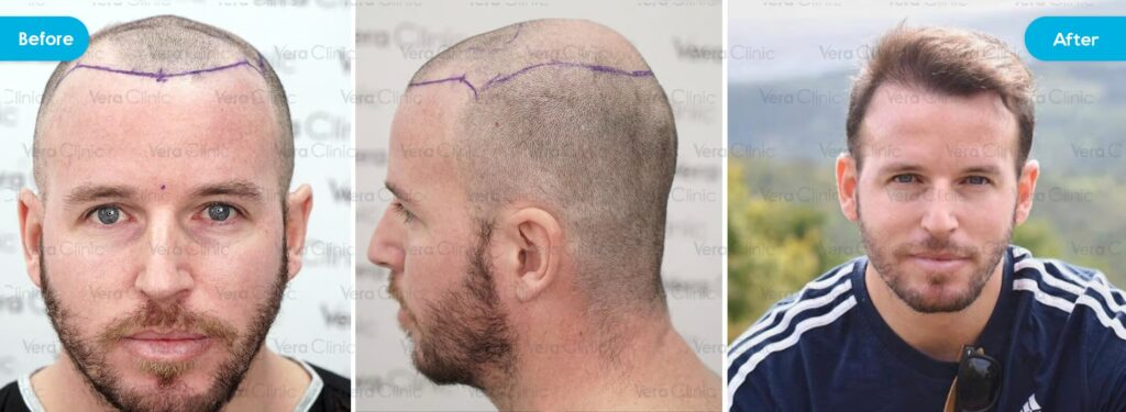 Vorteile der Haartransplantation mit modernster DHI-Technik