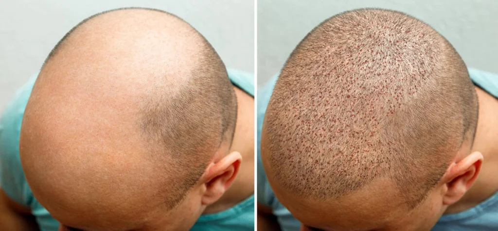 greffe de cheveux FUE ou DHI