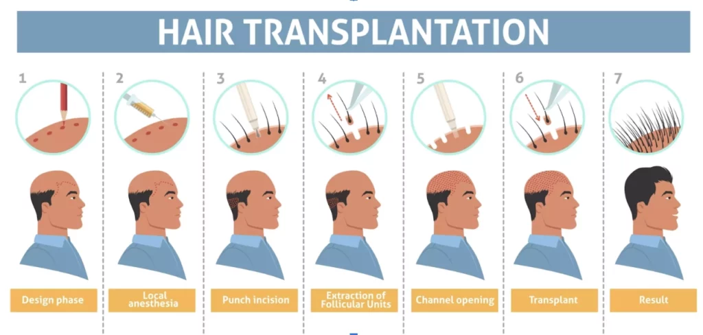 Hair Transplant Turkey