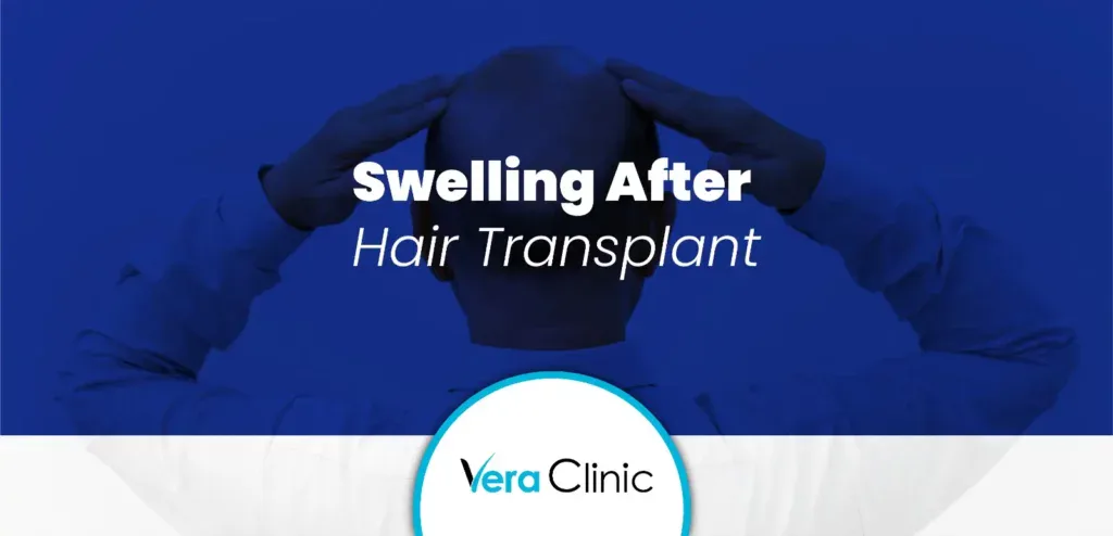 Swelling After Hair Transplant