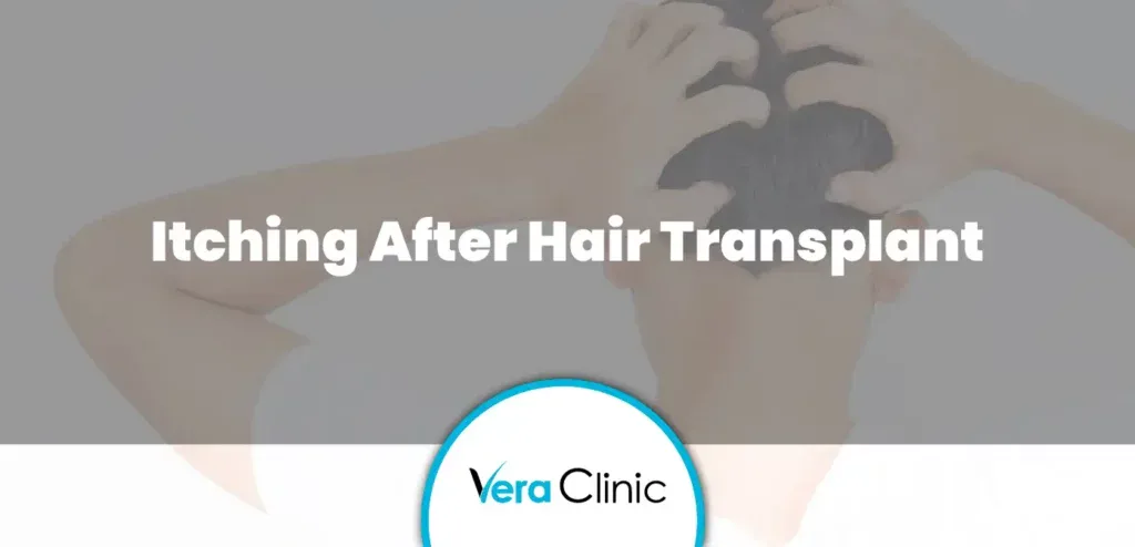 Itching After Hair Transplant