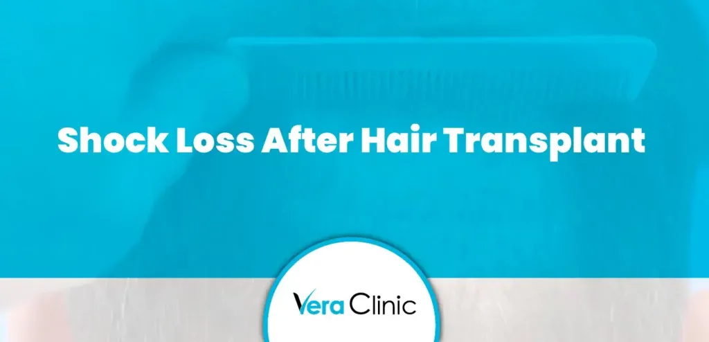 Shock Loss After Hair Transplant