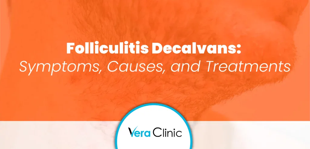 Folliculitis Decalvans