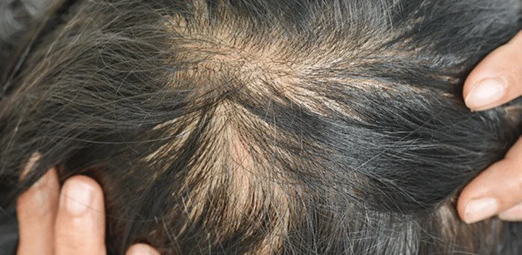 Dünnes Haar Kopfhaut sichtbare Frauenfrisuren Tipps und Tricks