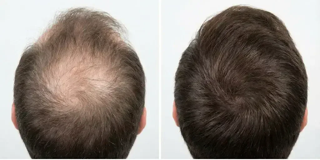 Ultra-realistic clinical comparison showing protein deficiency hair loss