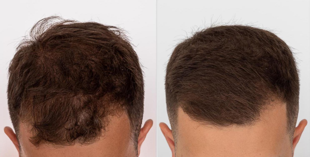 minoxidil cheveux homme
