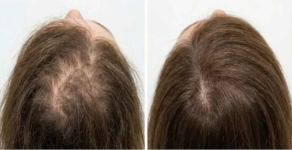 Como fica o cabelo antes e depois da queda de cabelo por desnutrição Imagem clínica ultra-realista do «antes» e «depois» que mostra a queda de cabelo relacionada com a desnutrição