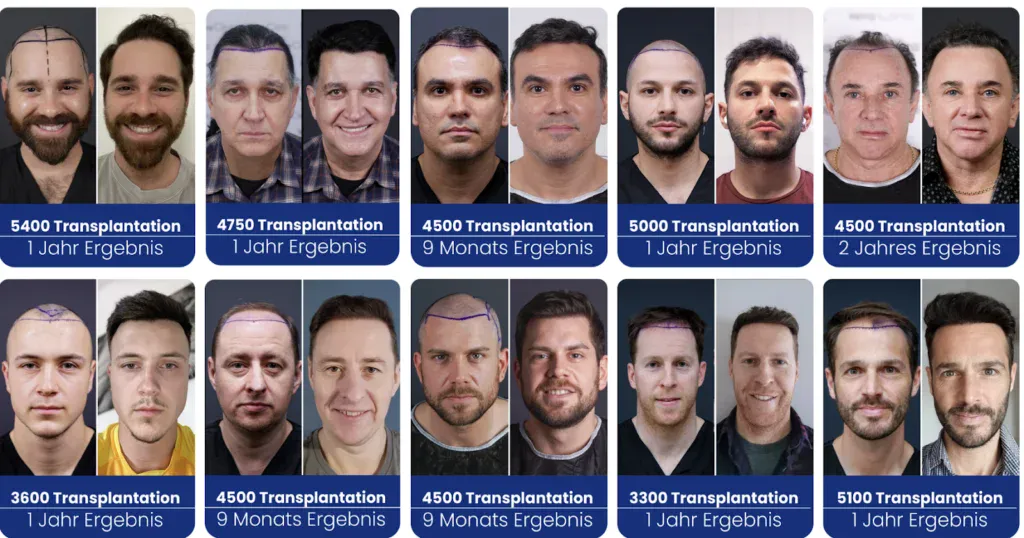 Was ist die FUE Haartransplantation?