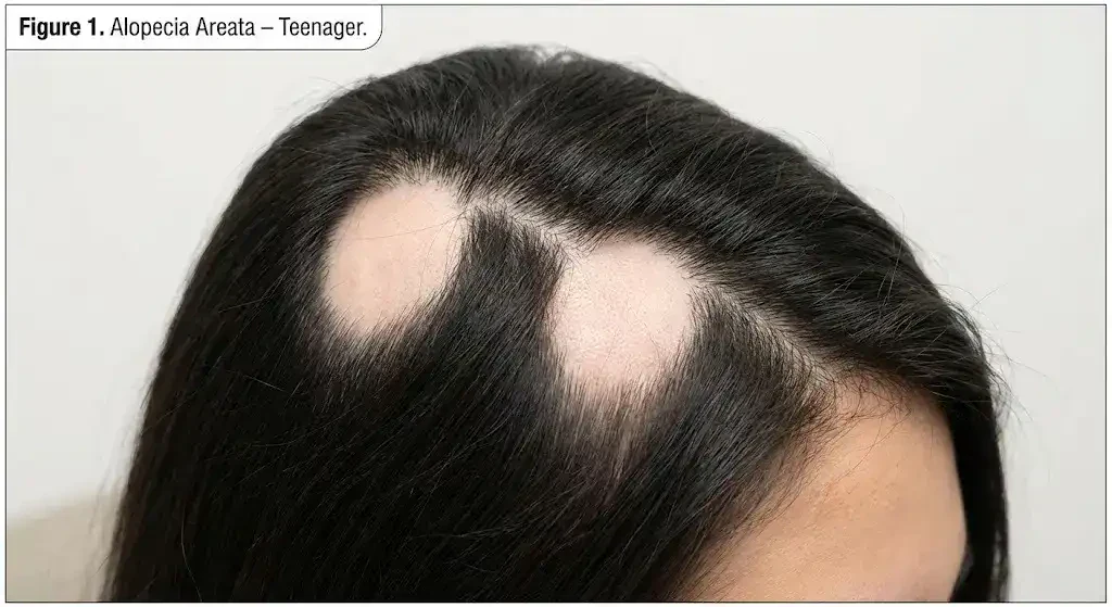 Alopecia Areata Alopecia Areata
