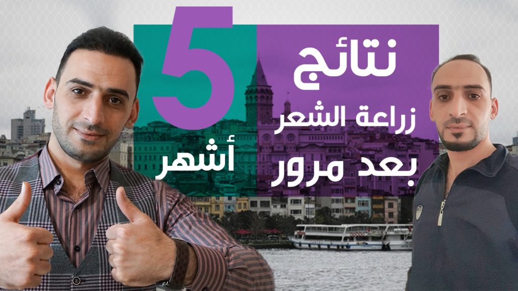 Results of hair transplantation in Turkey