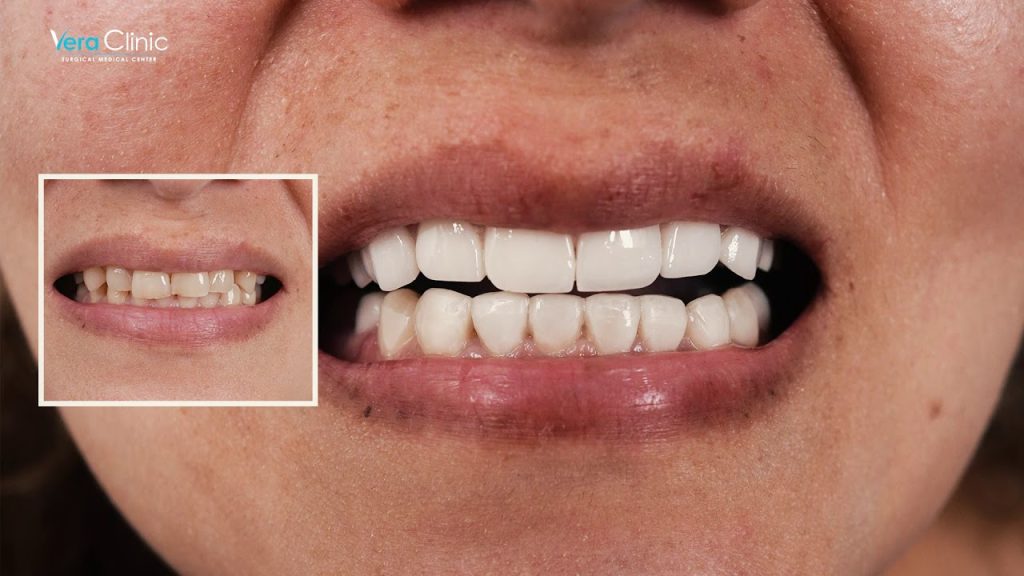 teeth whitening b&A