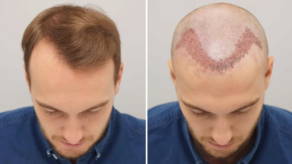 Greffe de cheveux FUE prix