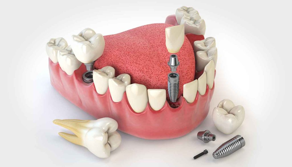 Dental implants model