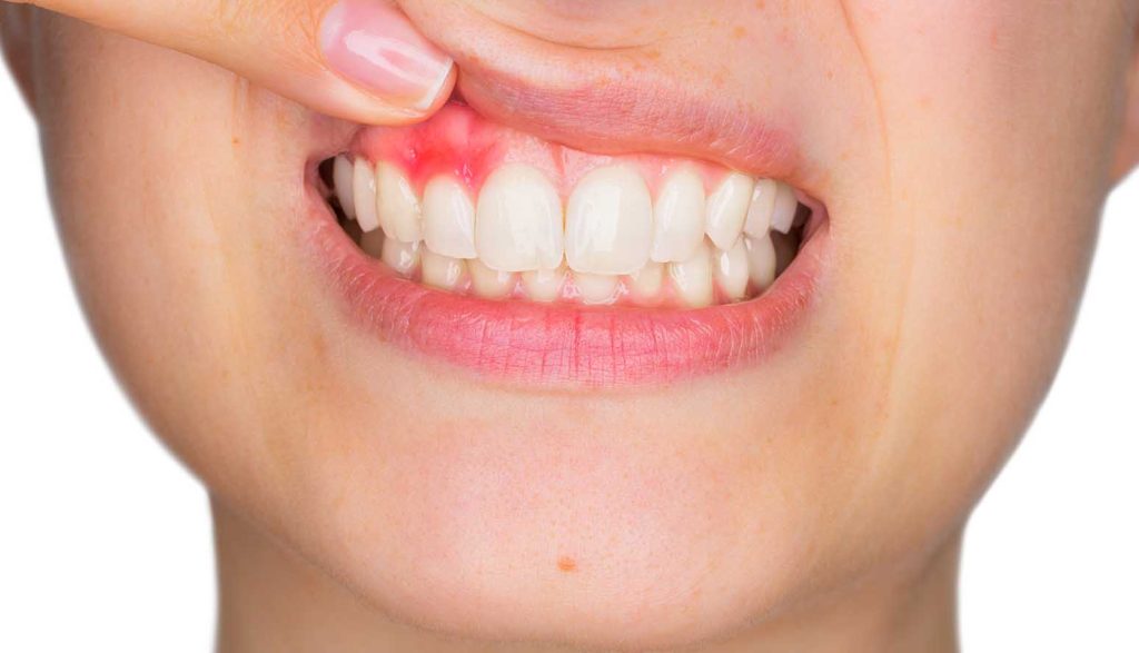 gingivitis