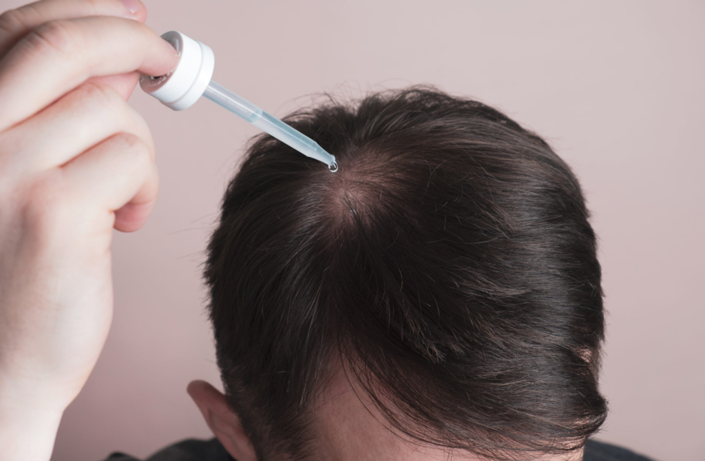 Efficacité du Minoxidil cheveux pour les femmes et les hommes