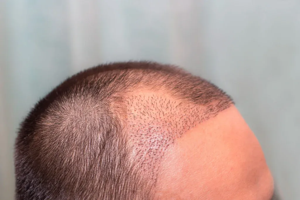Phasen des Haartransplantation Heilungsverlauf