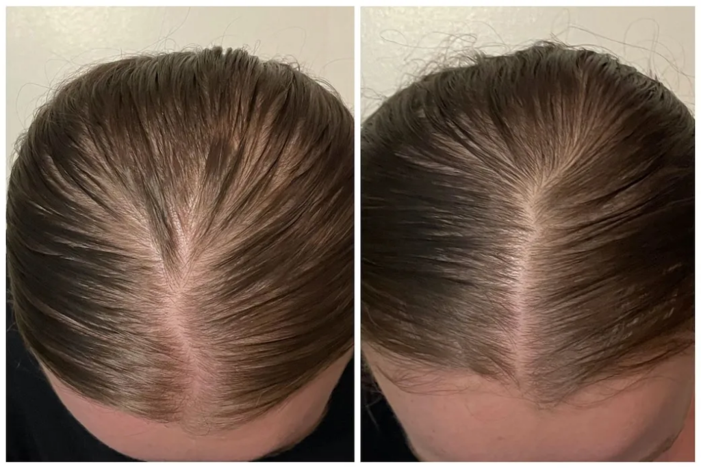 minoxidil cheveux femme
