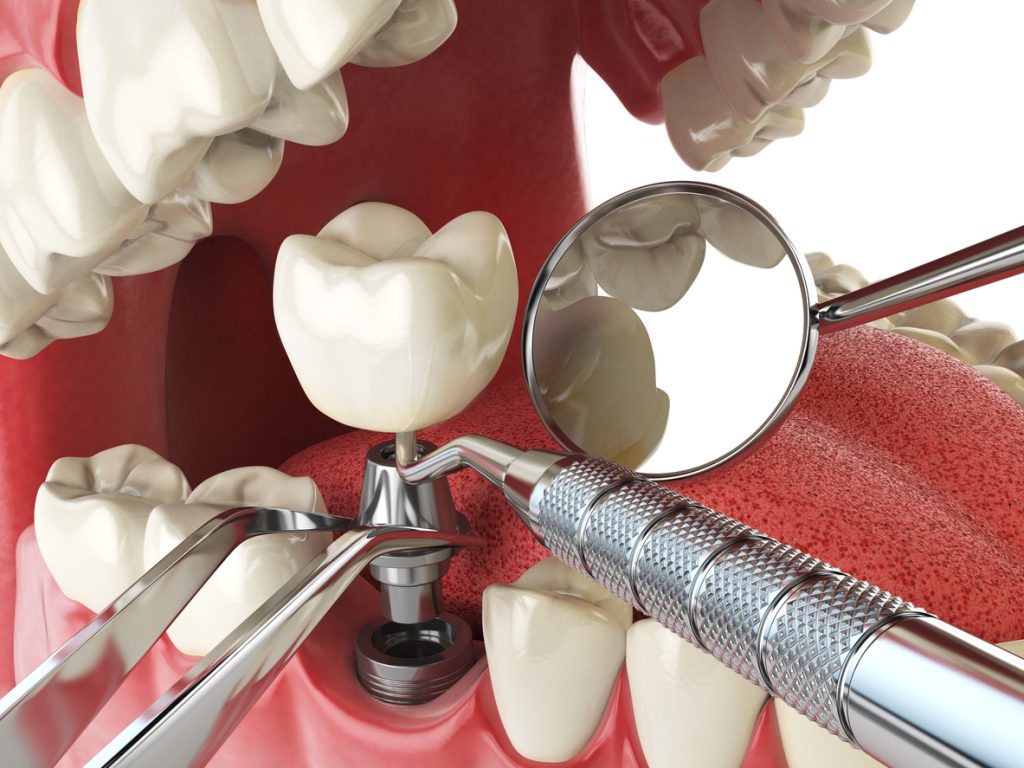 Implant dentaire