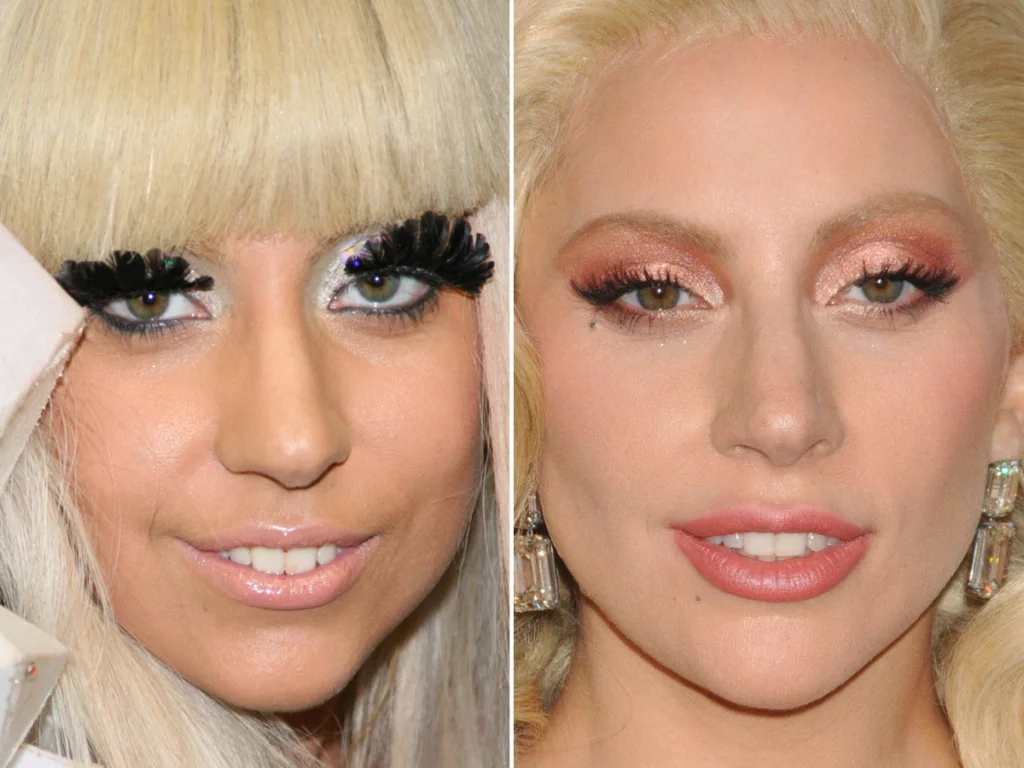 Lady Gaga's Lips: Did She Go Under the Needle?