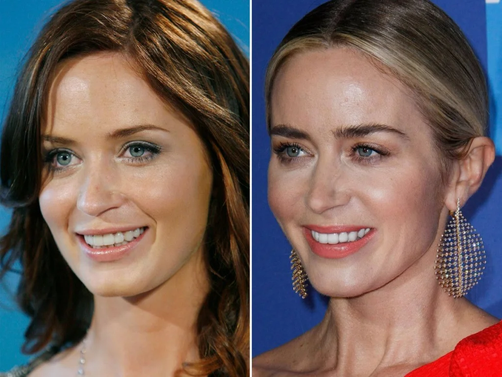 Emily Blunt Facelift