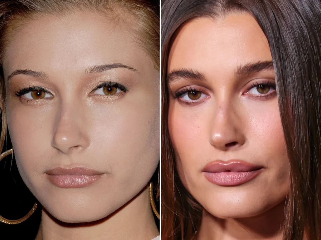 Hailey Bieber Lip Injection